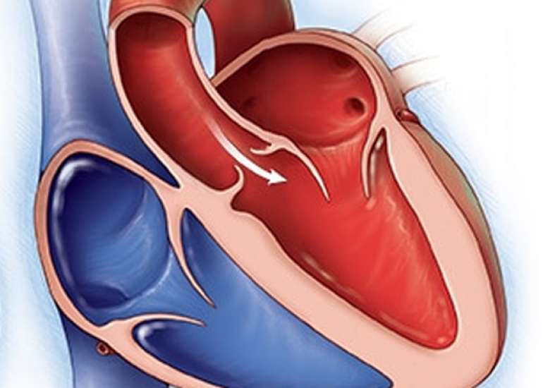 How we manage a VSD with some degree of aortic regurgitation?