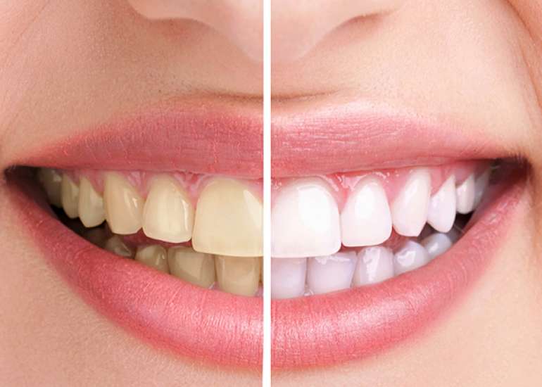 How to remove Brown Stain from Teeth