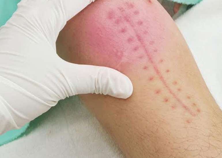 How common is infection after knee replacement?