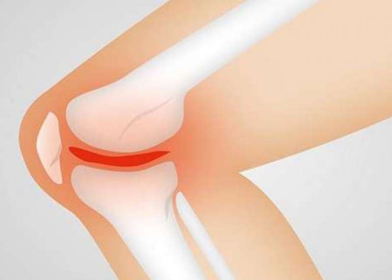 How common is osteoarthritis knee in india?