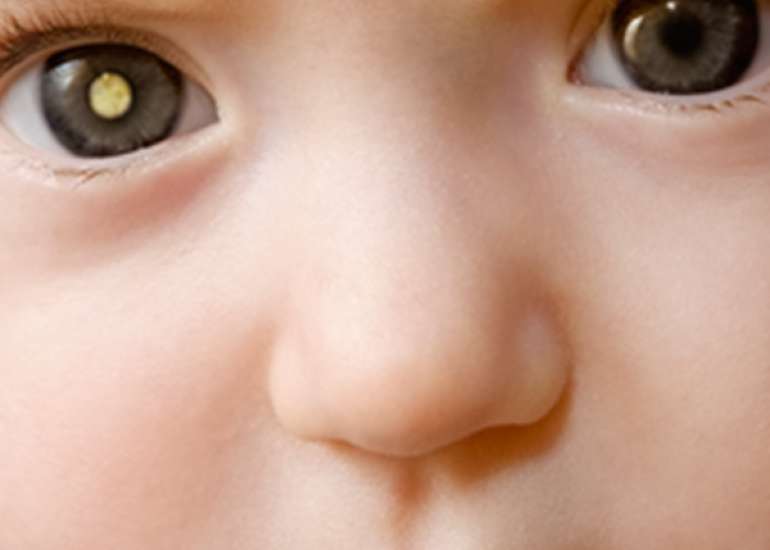 How is cataract managed in children?