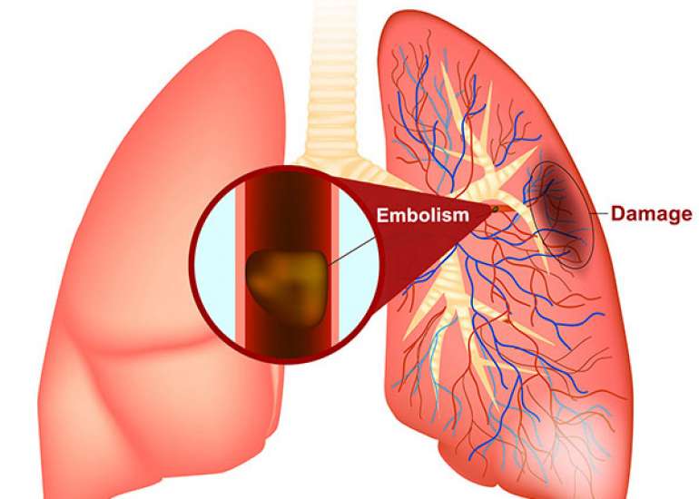 How is pulmonary embolism diagnosed?