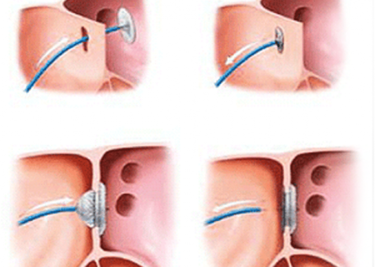 How should we differentiate PFO from ASD?
