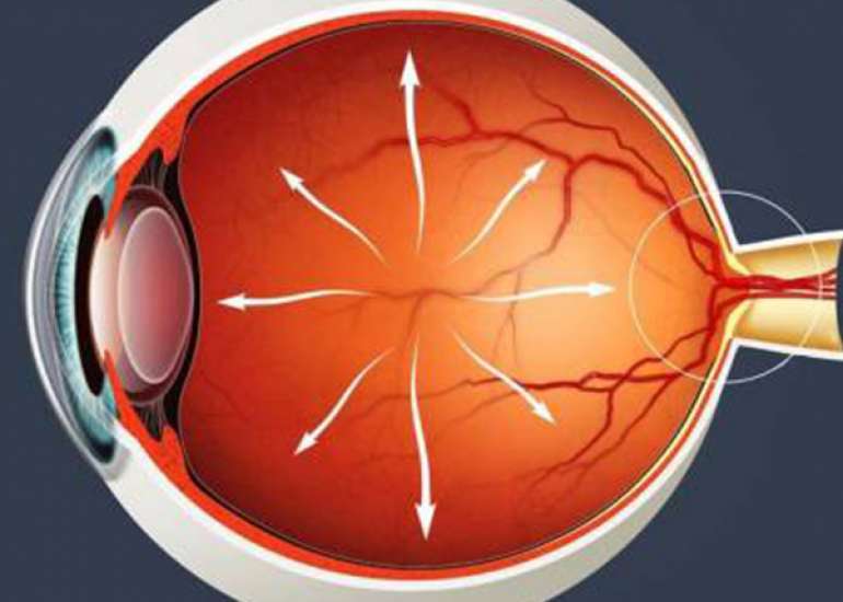 How should we set target IOP?