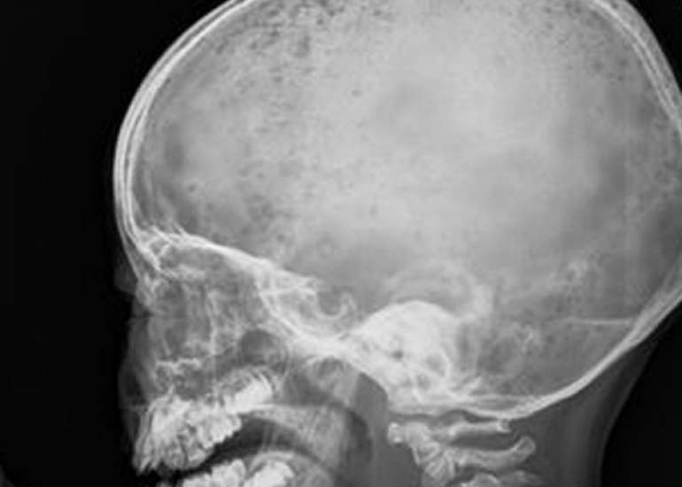 Hypercalcemia in a pediatric patient