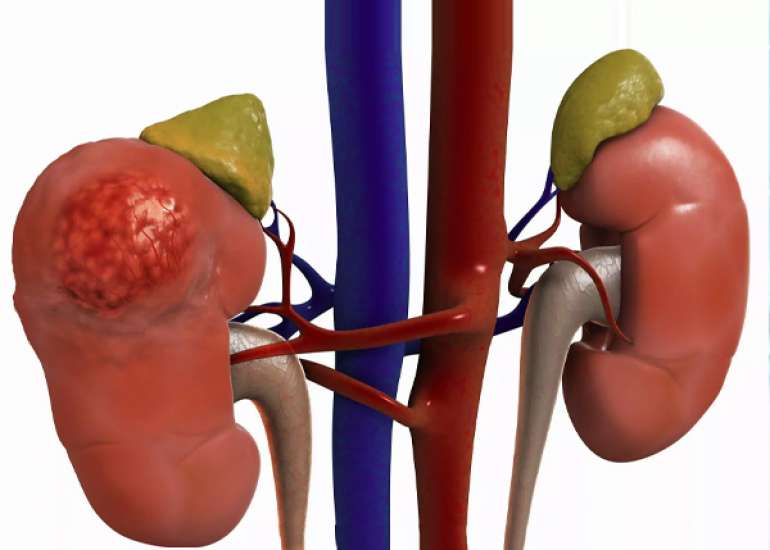 I have heard that probiotics can improve CKD Is it true?