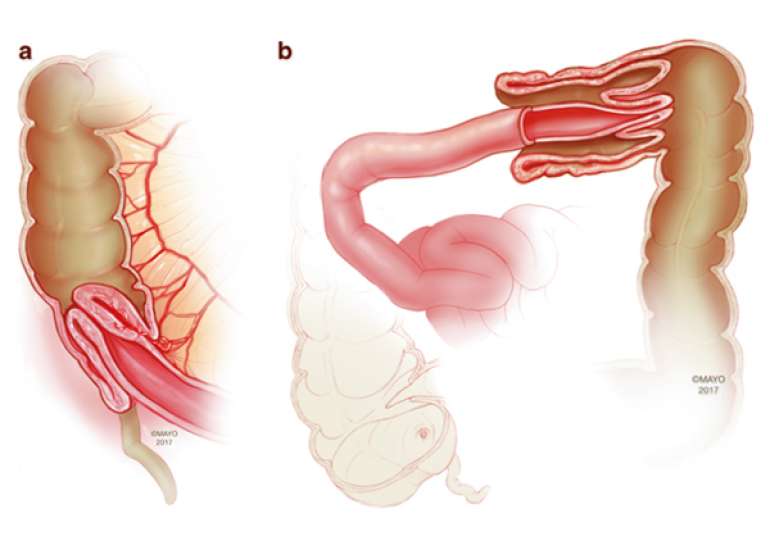 Ileocolic Intussusception Management in Pediatric Patients