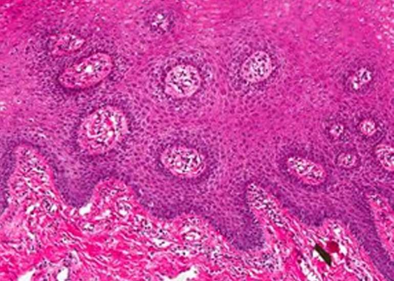 Infantile Perianal Pyramidal Protrusion, presenting as a skin tag