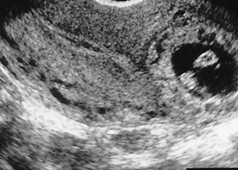 Interstitial Pregnancy: Case Report of Atypical Ectopic Pregnancy.