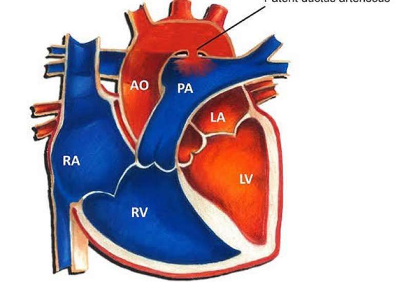Intervention in a case with PDA (Patent Ductus Arteriosus)?