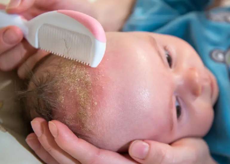 Interventions for infantile seborrheic dermatitis (including cradle cap)