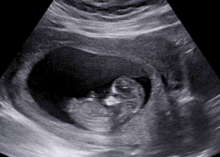 Intramural pregnancy: A case report.