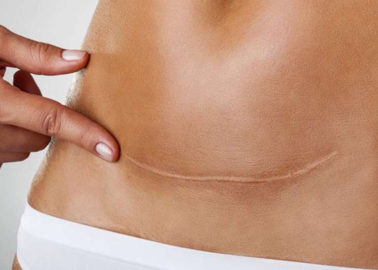 Intrathecal bupivacaine with buprenorphine confers prolonged analgesia during C-sections