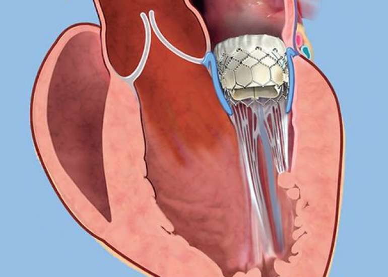 Is intervention necessary in rheumatic heart disease patient with mitral stenosis?