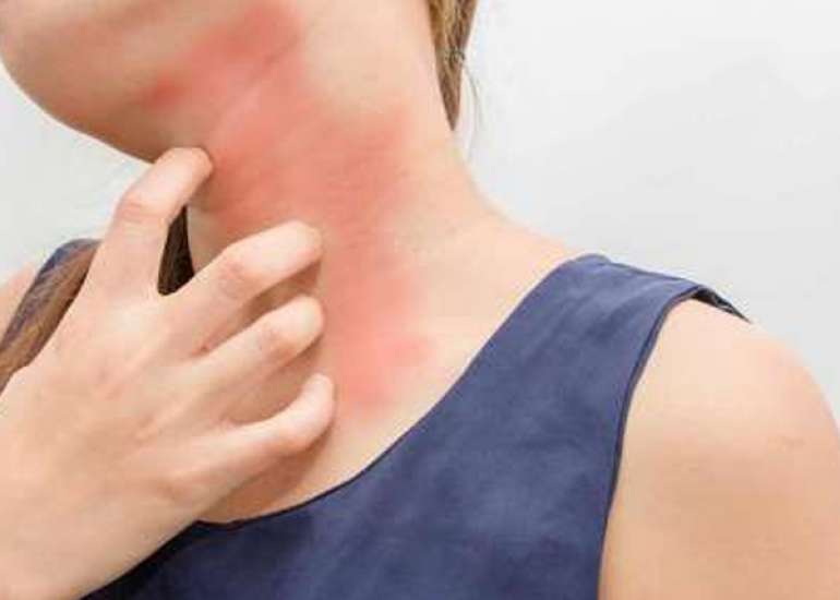 Is there a role of homeopathy in allergic disorders?