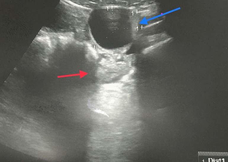 Isolated fallopian tube torsion in term pregnancy