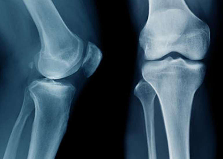 Knee X-rays for Abnormality Detection