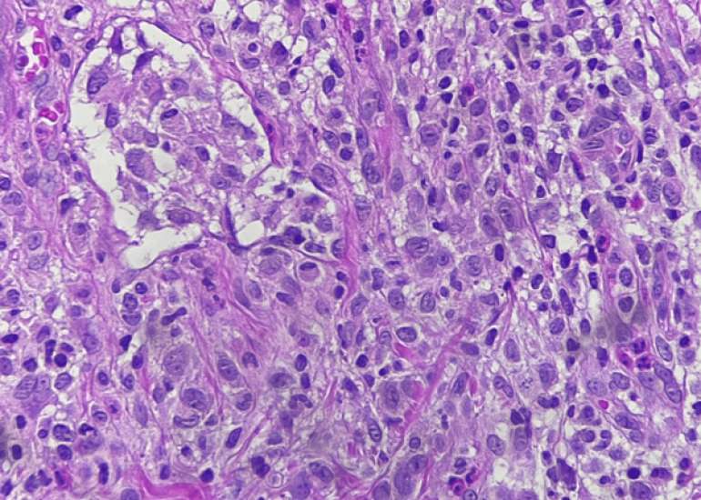 Langerhans Cell Histiocytosis Presented as Persistent Diaper Dermatitis