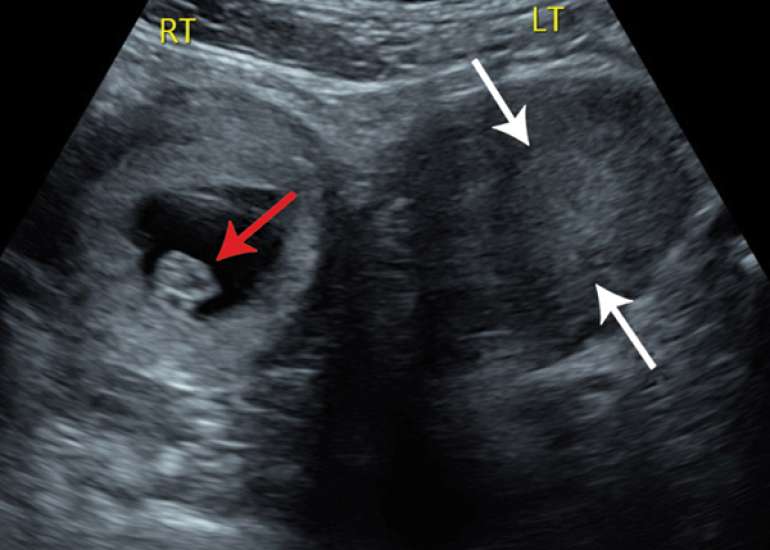 Laparoscopic Cerclage for Cervical Insufficiency in a Unicornuate Uterus with Previous Failed McDonald Cerclage: Successful Outcome