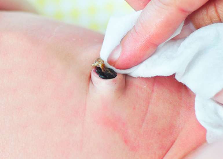 Large umbilical endometrioma: A case study