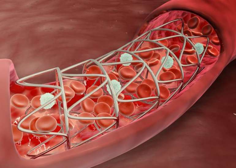 Late restenosis after primary PCI?