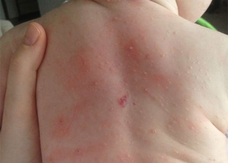 Letterer-siwe disease presenting as a retro auricular swelling-a diagnostic dilemma