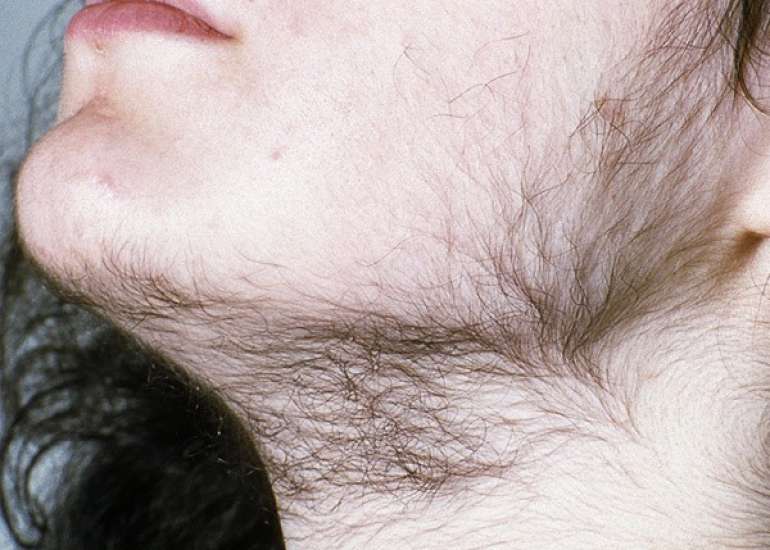 Levels of Renin and D-dimer in women with polycystic ovary disease