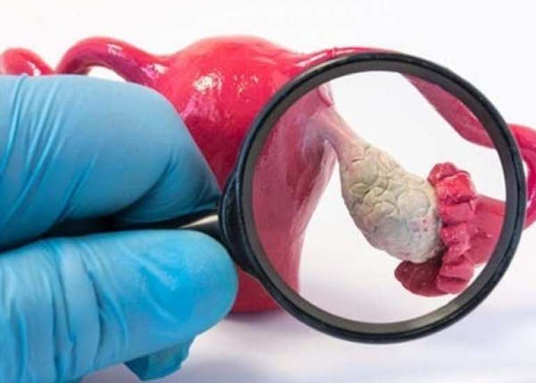 Lifestyle Approaches to Managing PCOS