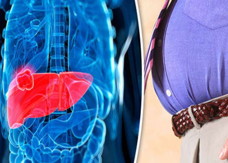 Liver Disease in Obesity