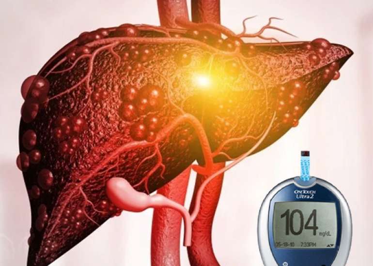 Diabetes and Chronic Liver Disease