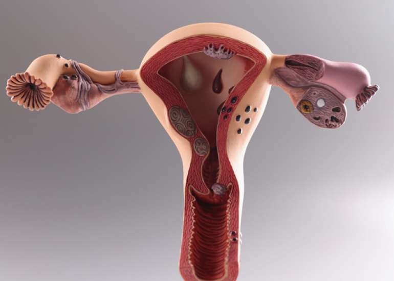 Long-Term Health Implications of Polycystic Ovarian Disease