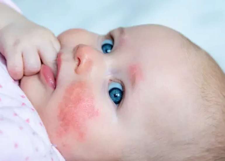 Lower Serum Interleukin-33 Levels in Infantile Atopic Dermatitis