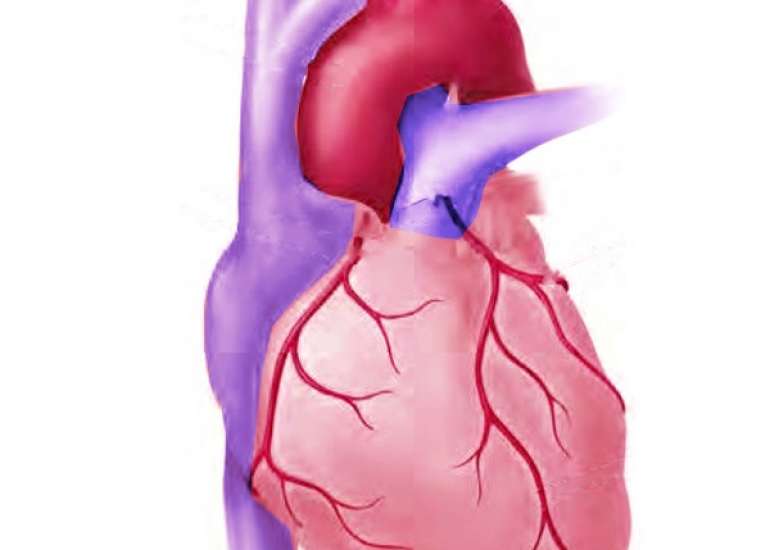 MI with normal coronaries?
