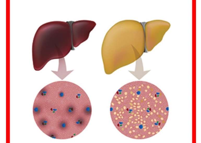 Management of NAFLD and NASH