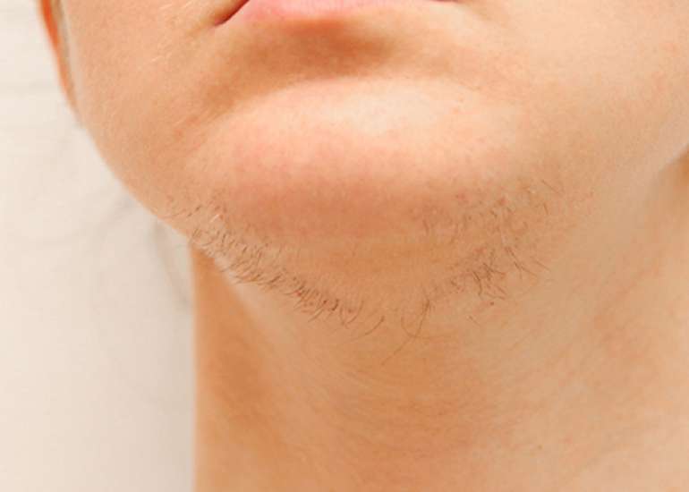 Management of Acne Vulgaris and Hirsutism in Polycystic Ovary Syndrome (PCOS) in Females