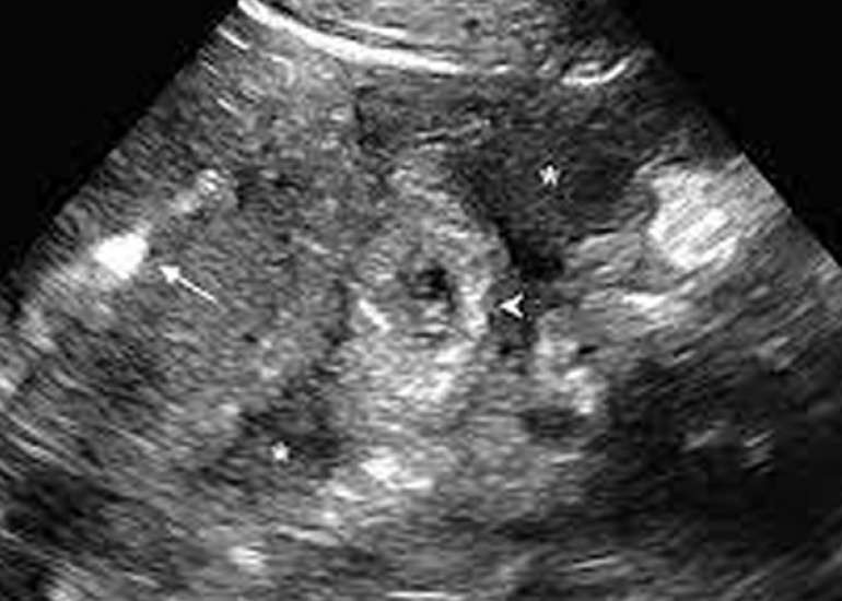 Management of Cervico-Isthmic Pregnancy with Fetal Death: A Case Report and Considerations for Fertility Preservation