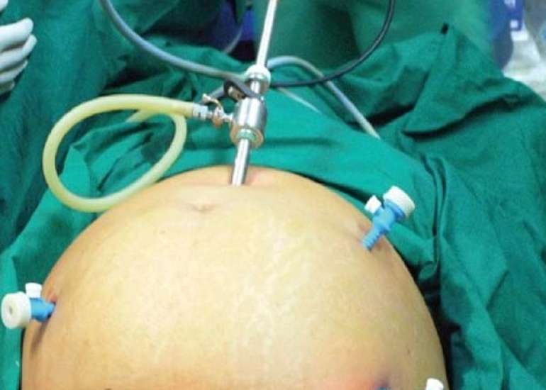 Management of venous thromboembolism as a complication after Total laparoscopic hysterectomy with bilateral salpingectomy