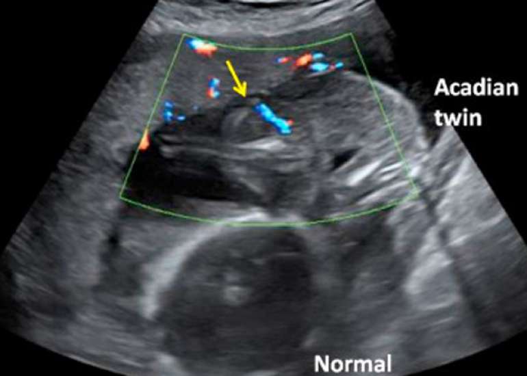 Management of a Delayed Diagnosed Acardiac Twin Pregnancy with TRAP Sequence