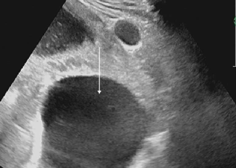 Management of breech presentation with a large pelvic hydatid cyst in late pregnancy