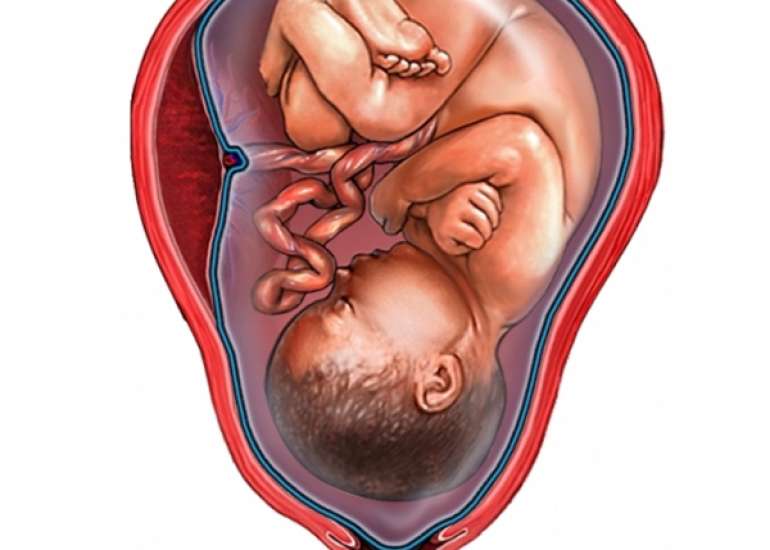 Managing Premature rupture of membranes at term