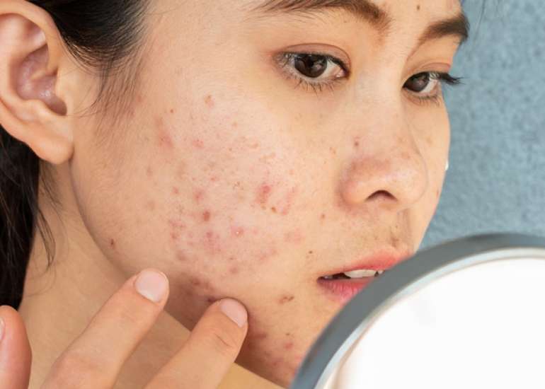 Managing Acne Vulgaris While Pregnant or Breastfeeding