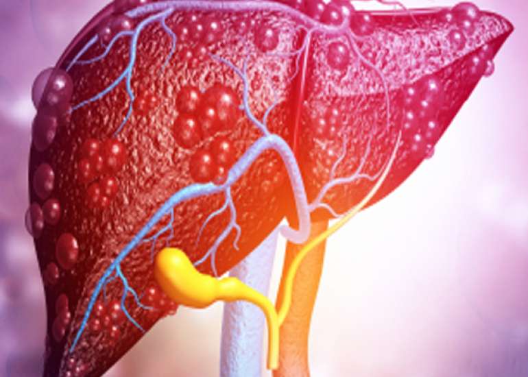 Managing NAFLD in Obese Individuals