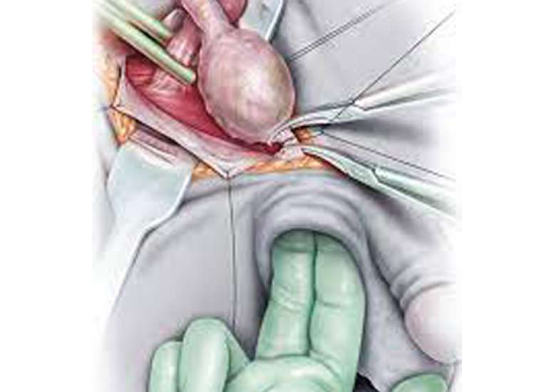 Managing Pediatric intratesticular abscess with a testicular sparing approach