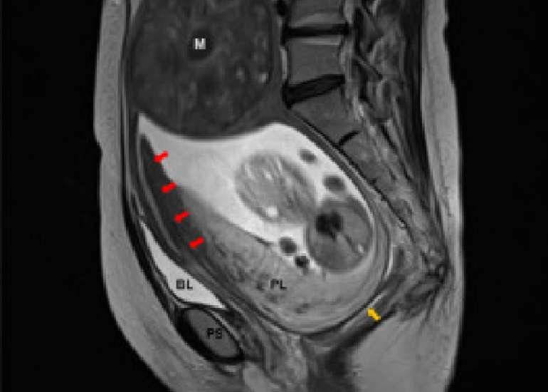 Managing an incarcerated uterus in a gynaecological patient surgically.