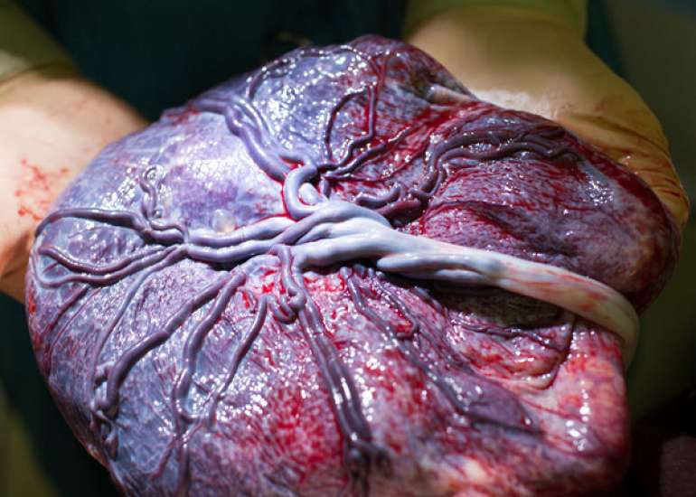 Manual Placenta Removal causes Increased Postpartum Prescriptions of Antibiotics