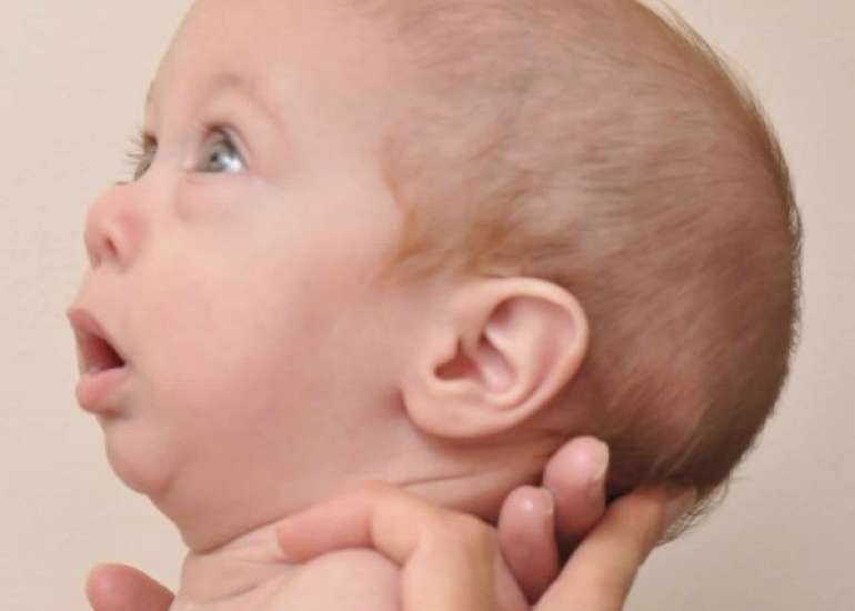 माइक्रोगैनेथिया क्या है? कारण, लक्षण और इलाज | Micrognathia in Hindi