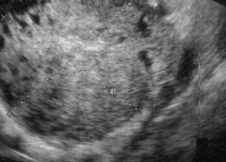 Missed mixed germ cell tumor of the ovary in pregnancy