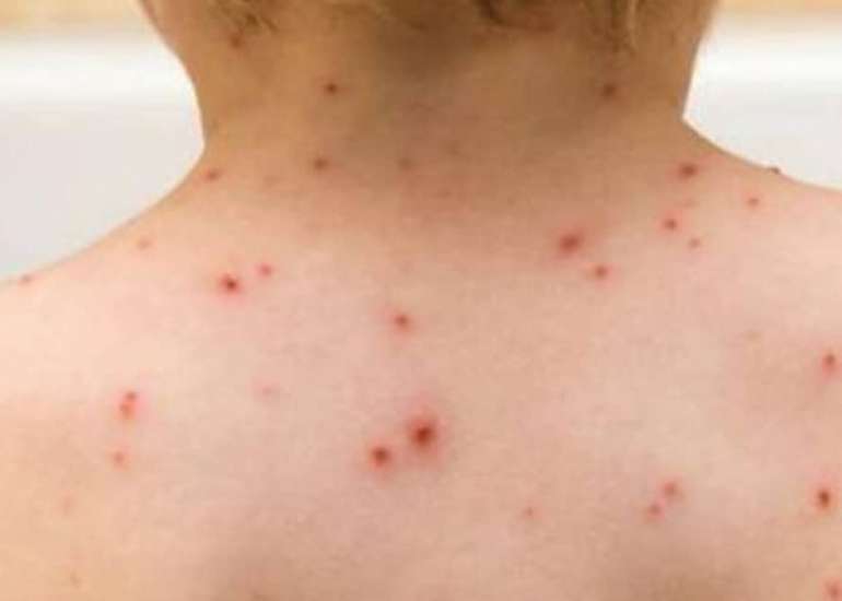 Monkeypox in pediatric age