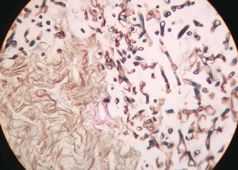 Mucormycosis of pouch of douglas in a diabetic lady: Report of a rare case