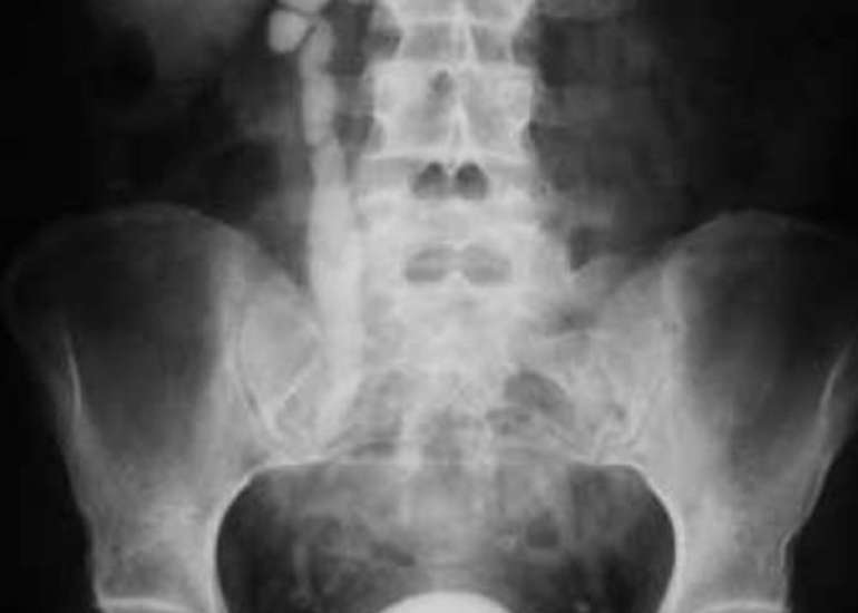 Multiple developmental urogenital anomalies - A therapeutic challenge